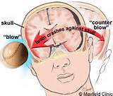 Brain Bleed Caused By Head Trauma