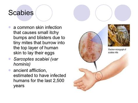 scabies