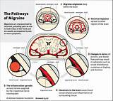 Symptoms Of Migraine Pictures