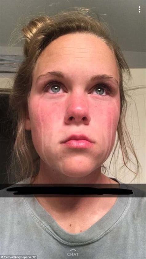Woman Cried After Applying Fake Tan And Is Left With Streaks Daily