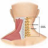Bulging Disc In Neck Surgery Images
