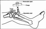 Io Infusion Intraosseous Bone Needle Marrow Aspiration Tibial Nejm Placement Proximal Into Stepwards Figure Illinois Iliac Sternal Location F1 sketch template