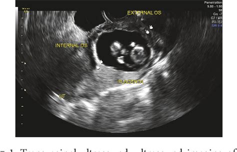 figure 1 from second trimester cervical ectopic pregnancy and