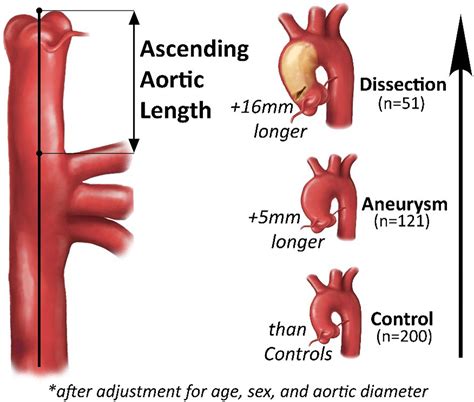 ascending aortic length   association  type  aortic