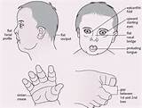 Photos of Down Syndrome Diagnosis