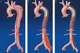 Images of Aortic Dissection Wiki