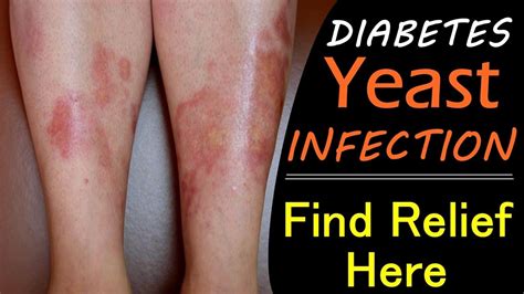 Diabetic Yeast Infection Home Remedies Get Relief At Home Starting