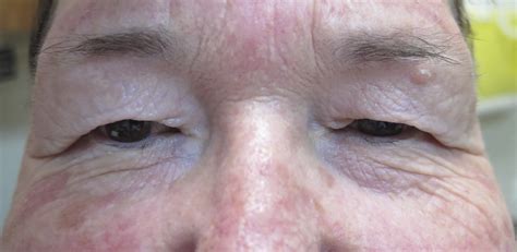 Excess Eyelid Skin And Or Fat Dermatochalasis And Blepharoplasty