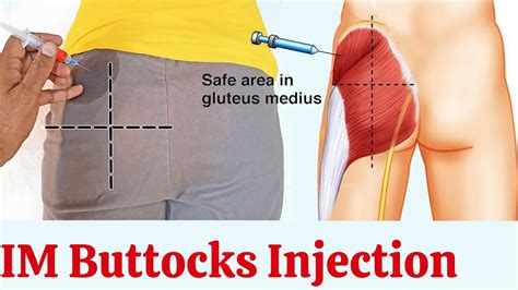How To Give Gluteal Muscle Injection At Home Intramuscular Injection