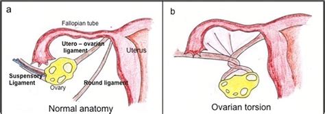 ovarian torsion medizzy