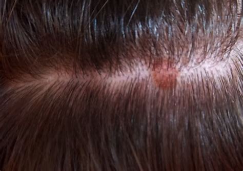itchy bumps  scalp treatment pictures symptoms
