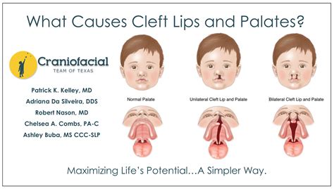 images  cleft palate cleft lip palate raphael  ason dmd md