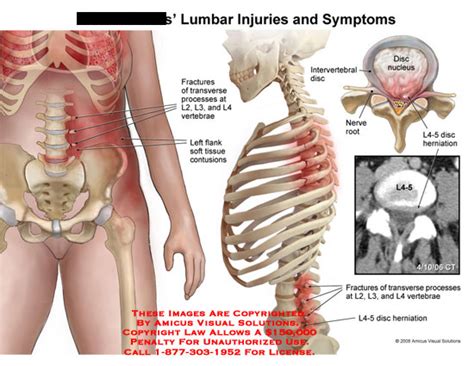 lumbar injuries  symptoms