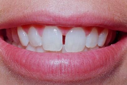 drguillermobernal oclusion dental defectuosa