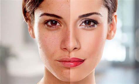 skin whitening  skin whitening treatment