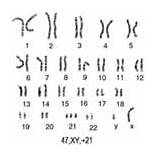Syndrome Karyotype Chromosome Trisomy Copies sketch template