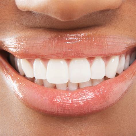 front teeth dental bridges lane associates