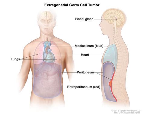 Extragonadal Germ Cell Tumors Vanderbilt Ingram Cancer Center