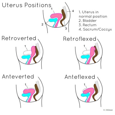 Retroverted Retroflexed Uterus Retroflexed Vs Retroverted Uterus