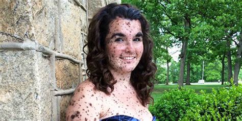 bullied teen covered in birthmarks is confident in herself