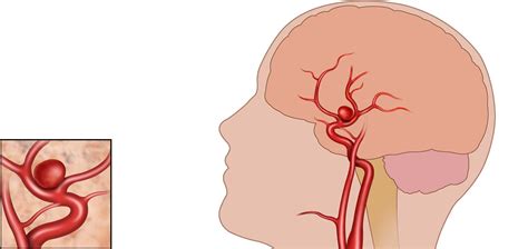 aneurysma symptome ursachen behandlung operation