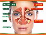 Images of Chronic Inflammation Nasal Passages
