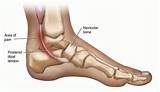 Images of Ankle Injuries