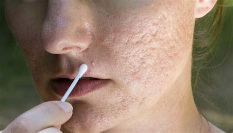 birth control pill as effective as antibiotics for acne management