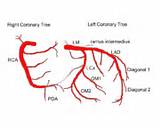 Photos of Posterior Descending Coronary Artery
