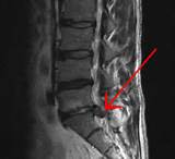 Images of Herniated Disc Symptoms