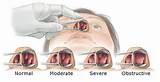 Images of Chronic Airway Obstruction