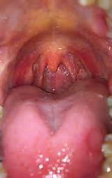 Images of Throat Cancer In Cats