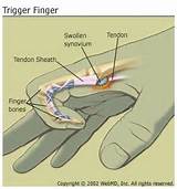 Trigger Finger Medical Condition Pictures