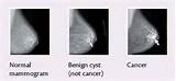 Images of Breast Lumps Without Pain