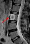 Photos of Benign Hemangioma Spine