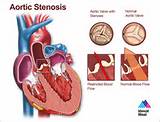 Severe Aortic Stenosis Images