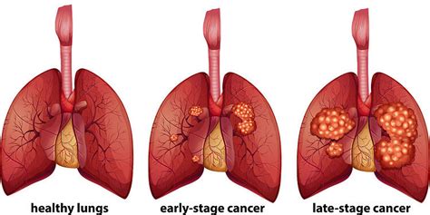 staging of lung cancer lung cancer stages