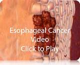 Esophageal Cancer Symptoms Images