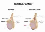 Pictures of What Causes Testicular Cancer