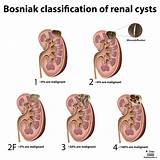 Images of Benign Kidney Cyst