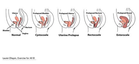 Uterine Prolapse To Be