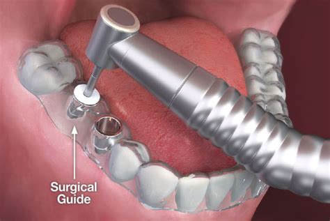 guided implant surgery  winchester dentist  smiles  virginia