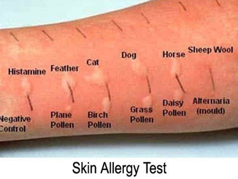 pruebas de alergia skin allergy test food allergies testing allergy testing