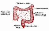 Images of Cancer In Transverse Colon