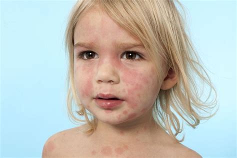 common childhood rashes   treat hives rash treatment rashes  children