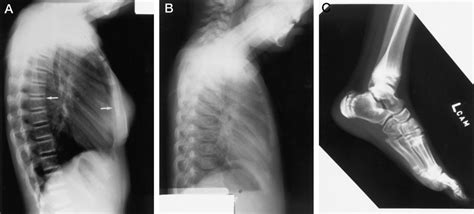 Radiographs Of An Ado Patient A Lateral Chest X Ray Of