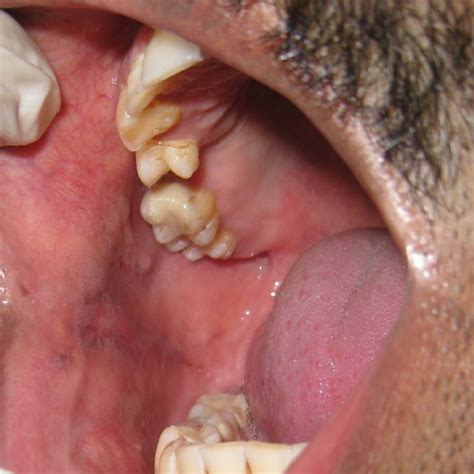post treatment clinical picture   buccal mucosa
