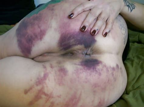 bruises 14 pics xhamster