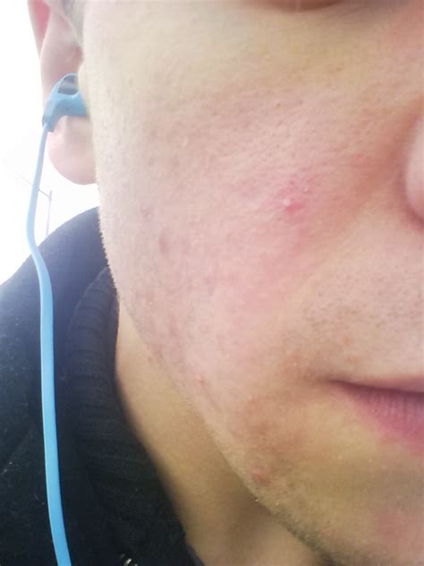 Acne Blackheads Scarring Help General Acne Discussion