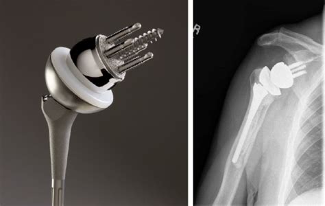 Shoulder Arthritis Reverse Total Shoulder Uw Orthopaedics And Sports